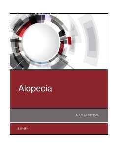 Alopecia